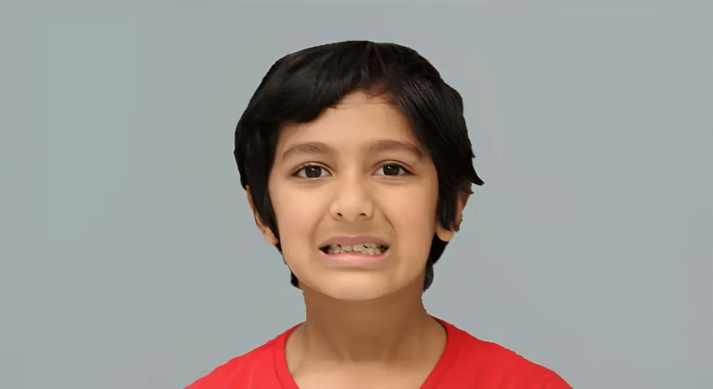 Orthodontic alignment in a child, case 7: before and after, before